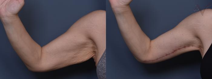 Before & After Arm Lift Case 434 Right Side View in Los Angeles, CA