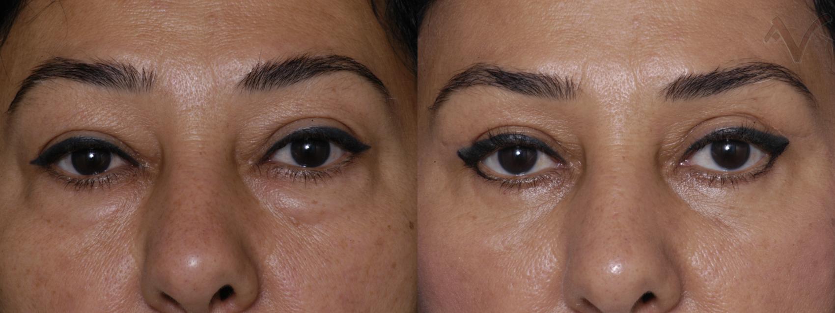 Before & After Combined Upper & Lower Eyelid Surgery Case 266 Front View in Los Angeles, CA