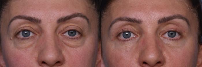 Before & After Combined Upper & Lower Eyelid Surgery Case 436 Front View in Los Angeles, CA