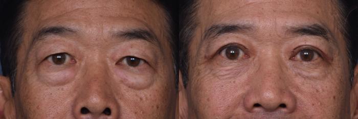 Before & After Combined Upper & Lower Eyelid Surgery Case 440 Front View in Los Angeles, CA