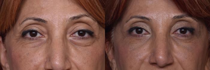 Before & After Combined Upper & Lower Eyelid Surgery Case 444 Front View in Los Angeles, CA