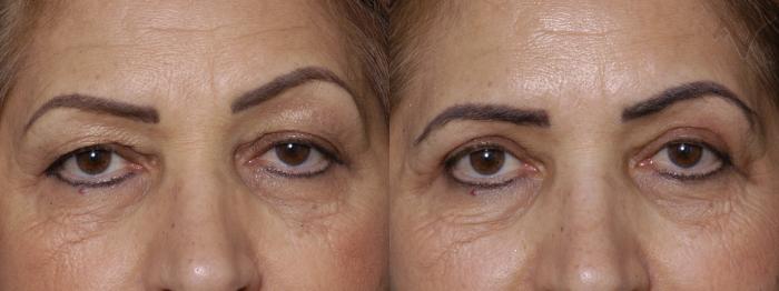 Before & After Eyelid Surgery Case 276 Front View in Los Angeles, CA