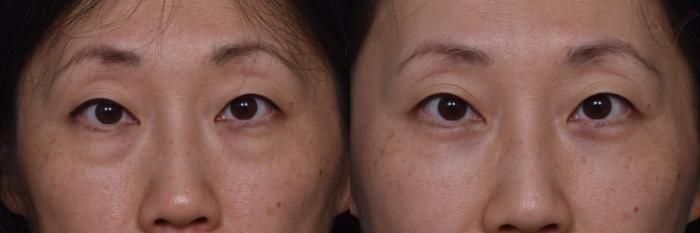 Before & After Lower Eyelid Surgery Case 445 Front View in Los Angeles, CA