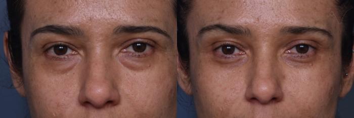 Before & After Lower Eyelid Surgery Case 448 Front View in Los Angeles, CA