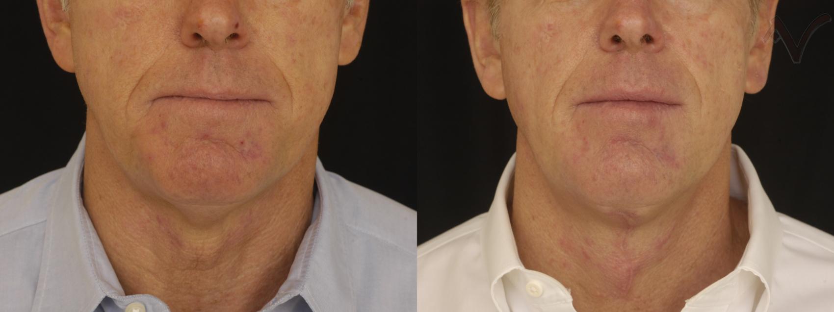 Before & After Neck Lift Case 235 Front View in Burbank, CA