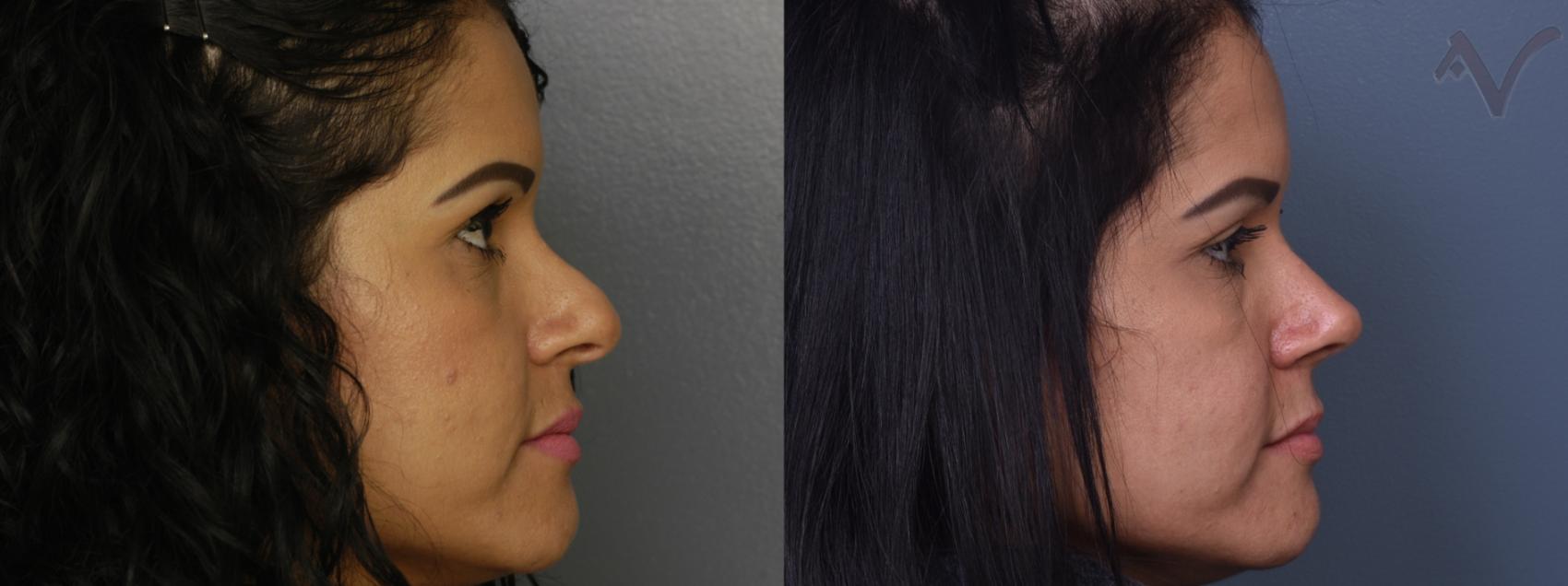 Before & After Revision Rhinoplasty Case 417 Right Side View in Los Angeles, CA