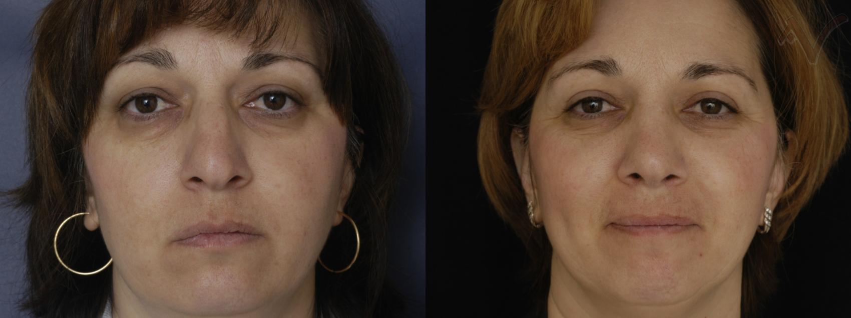 Before & After Rhinoplasty Case 254 Front View in Los Angeles, CA
