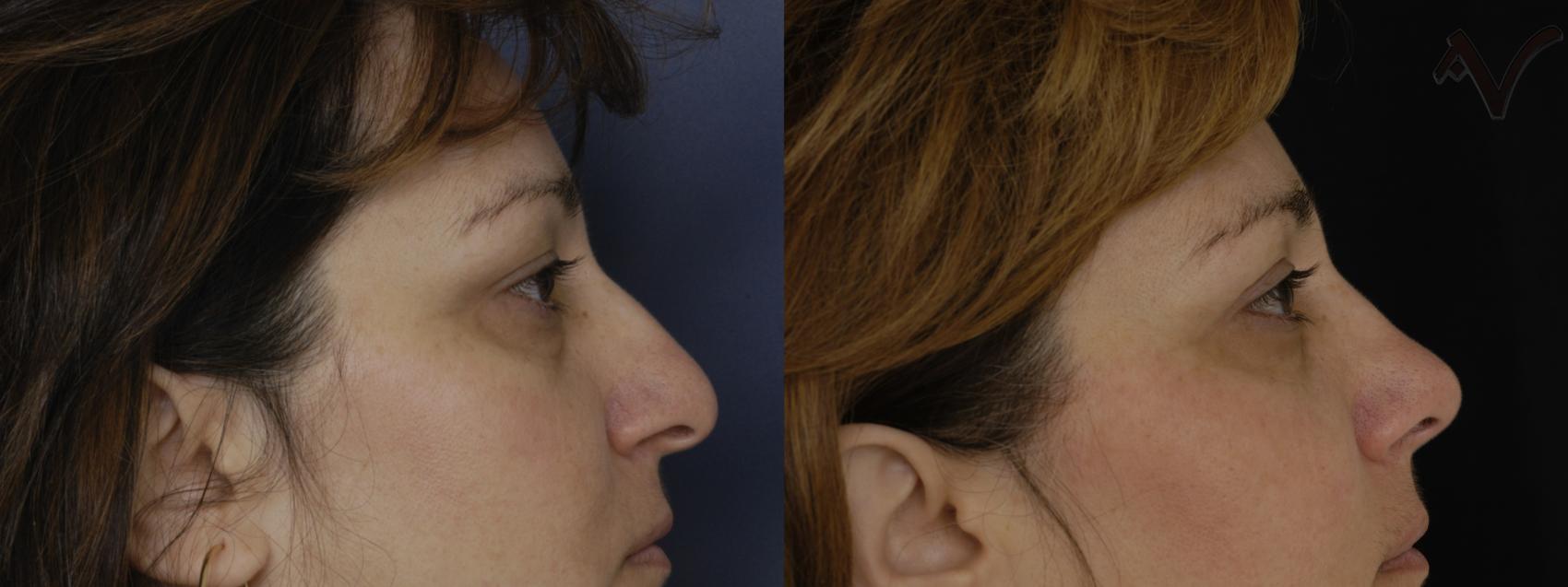 Before & After Rhinoplasty Case 254 Right Side View in Los Angeles, CA
