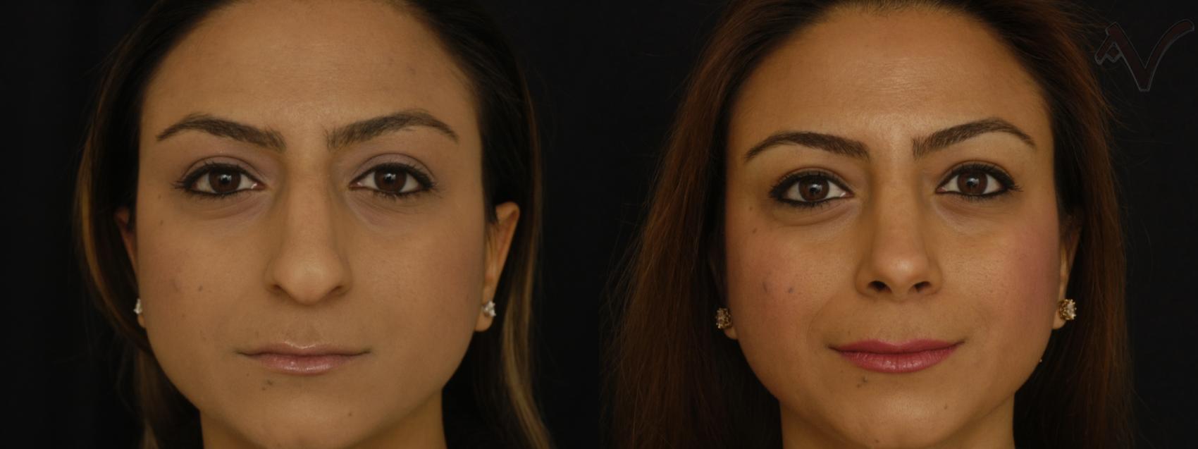 Before & After Rhinoplasty Case 260 Front View in Los Angeles, CA