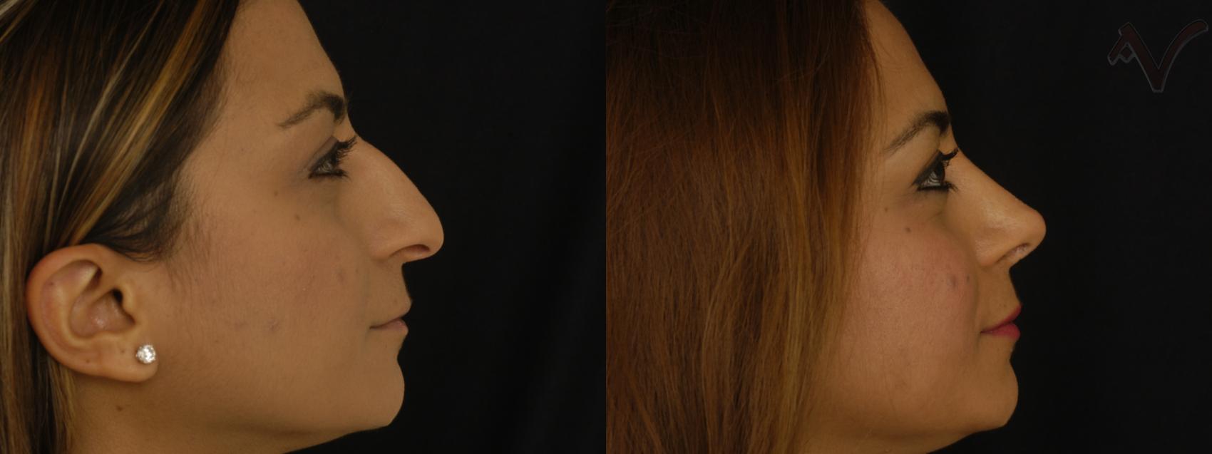 Before & After Rhinoplasty Case 260 Right Side View in Los Angeles, CA