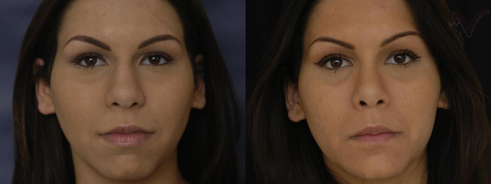 Before & After Rhinoplasty Case 262 Front View in Los Angeles, CA