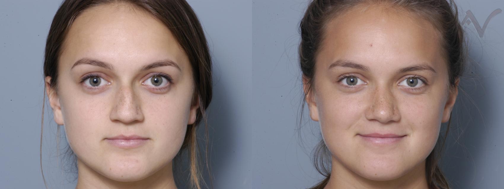 Before & After Rhinoplasty Case 3 Front View in Los Angeles, CA