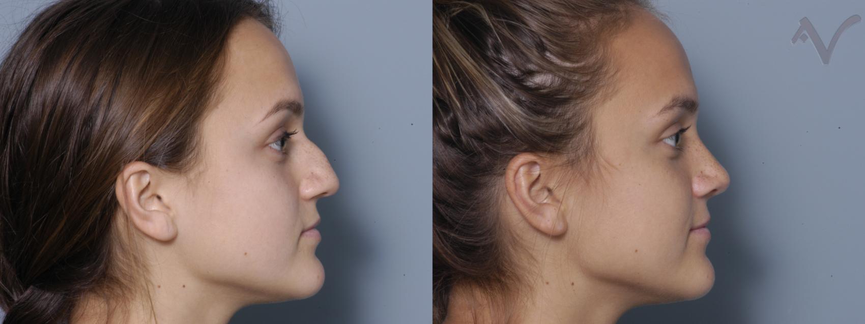 Before & After Rhinoplasty Case 3 Right Side View in Los Angeles, CA