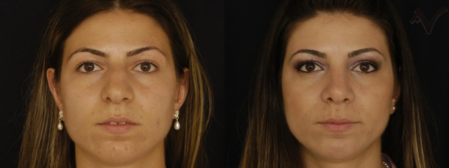 Before & After Rhinoplasty Case 307 Front View in Los Angeles, CA