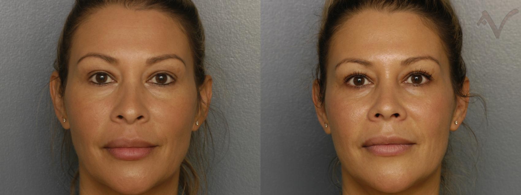 Before & After Rhinoplasty Case 309 Front View in Los Angeles, CA