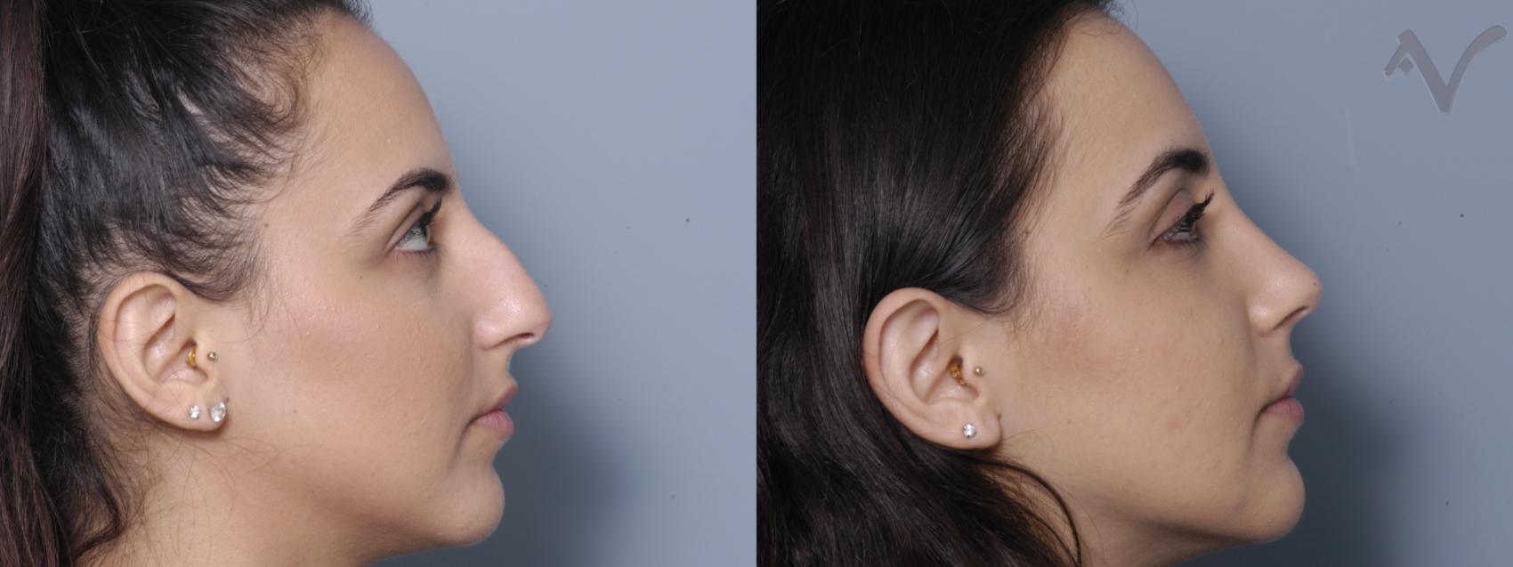 Before & After Rhinoplasty Case 330 Right Side View in Los Angeles, CA