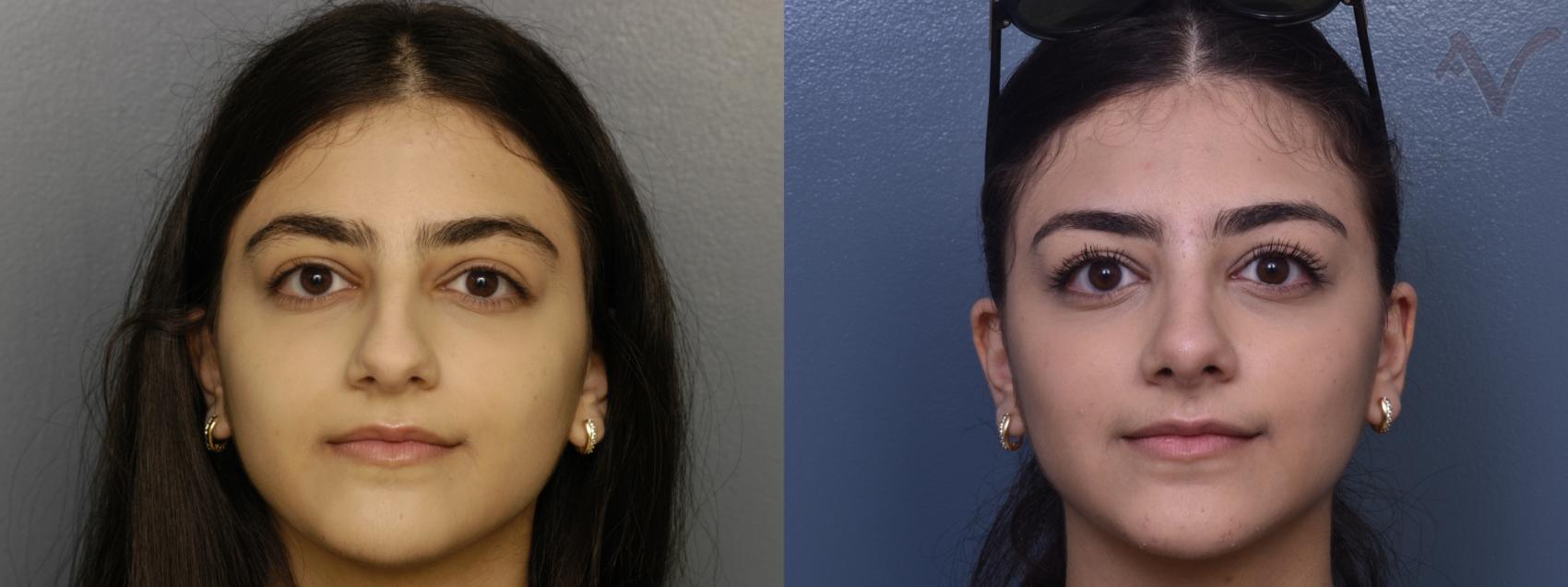 Before & After Rhinoplasty Case 366 Front View in Los Angeles, CA