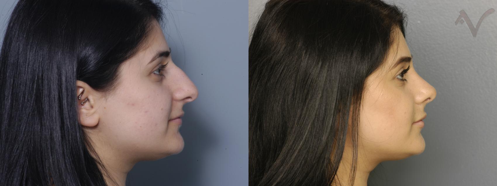 Before & After Rhinoplasty Case 4 Right Side View in Los Angeles, CA