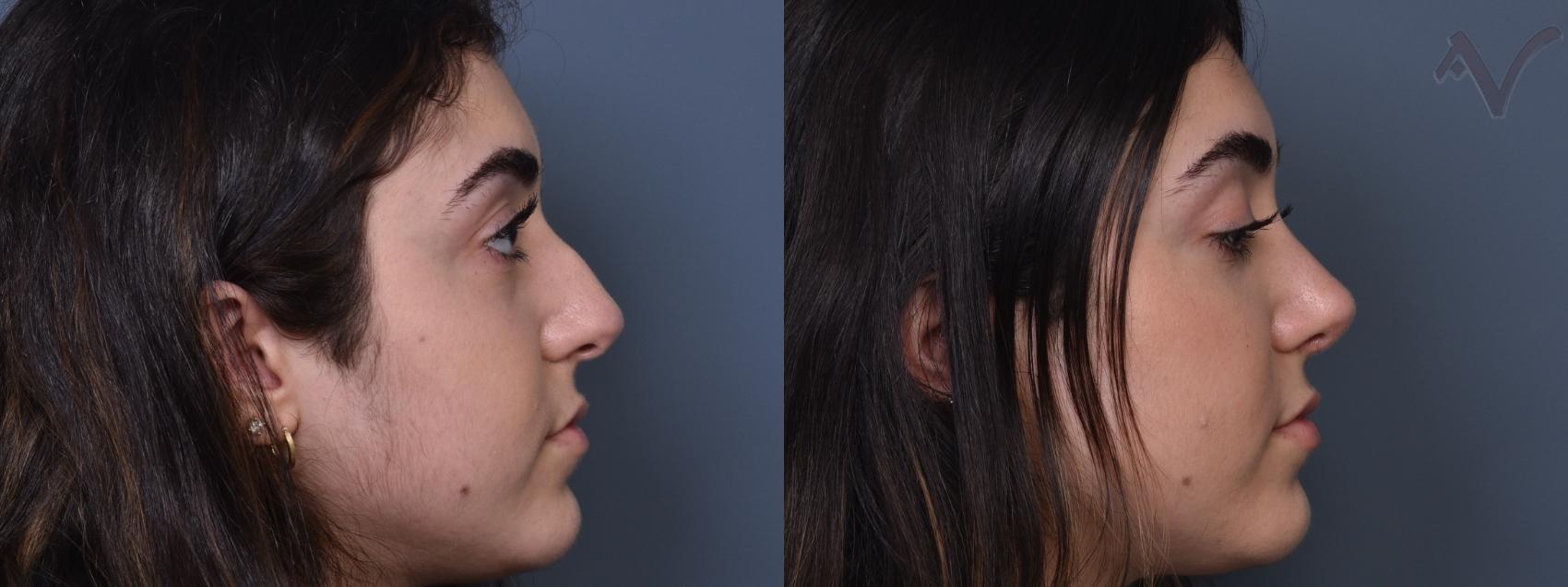 Before & After Rhinoplasty Case 415 Right Side View in Los Angeles, CA