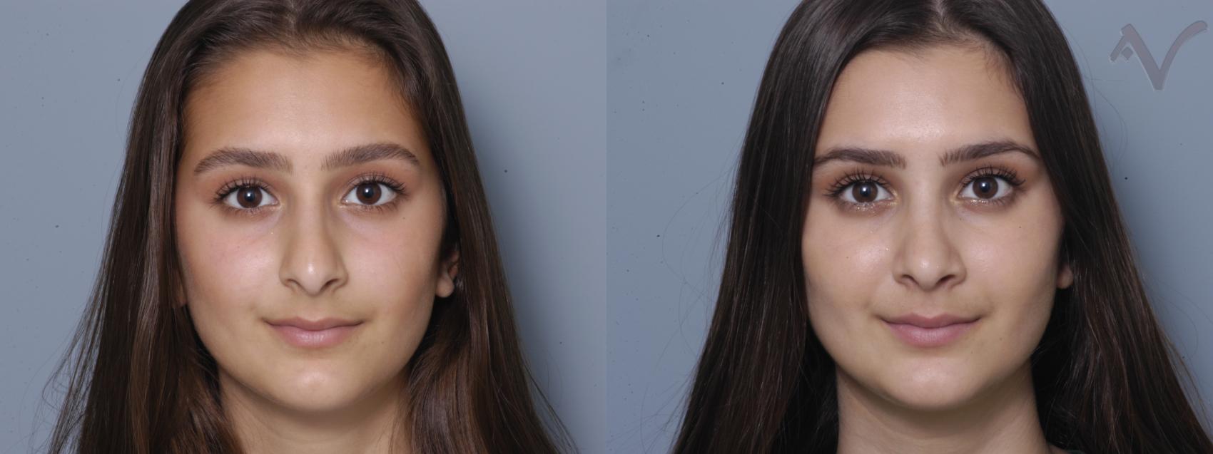 Before & After Rhinoplasty Case 5 Front View in Los Angeles, CA