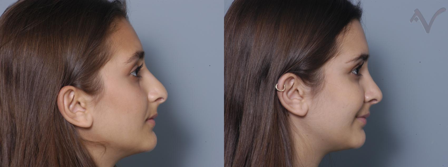 Before & After Rhinoplasty Case 5 Right Side View in Los Angeles, CA