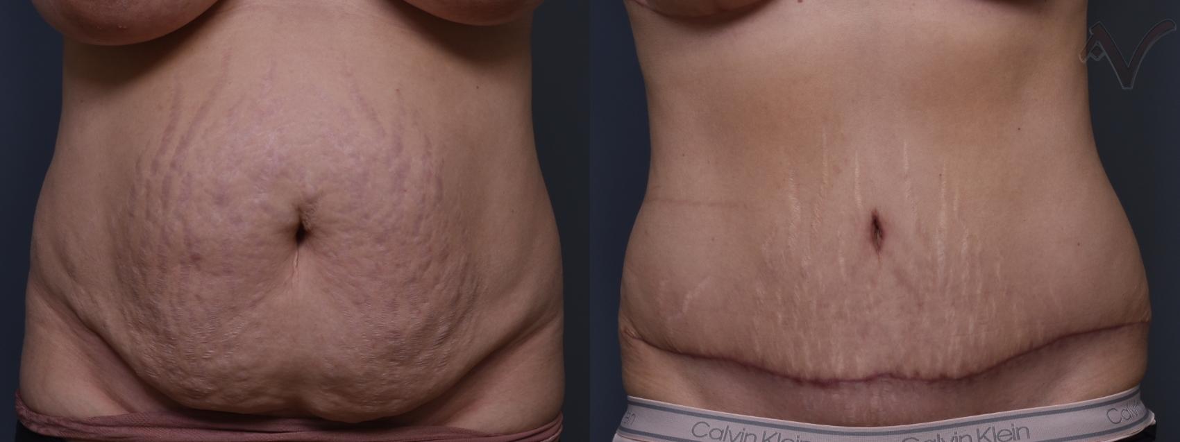 Before & After Tummy Tuck Case 419 Front View in Los Angeles, CA