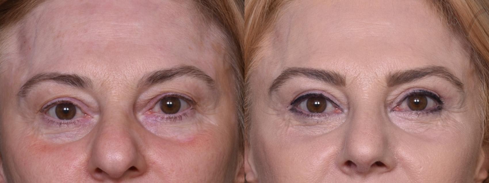 Before & After Upper Eyelid Surgery Case 392 Front View in Los Angeles, CA