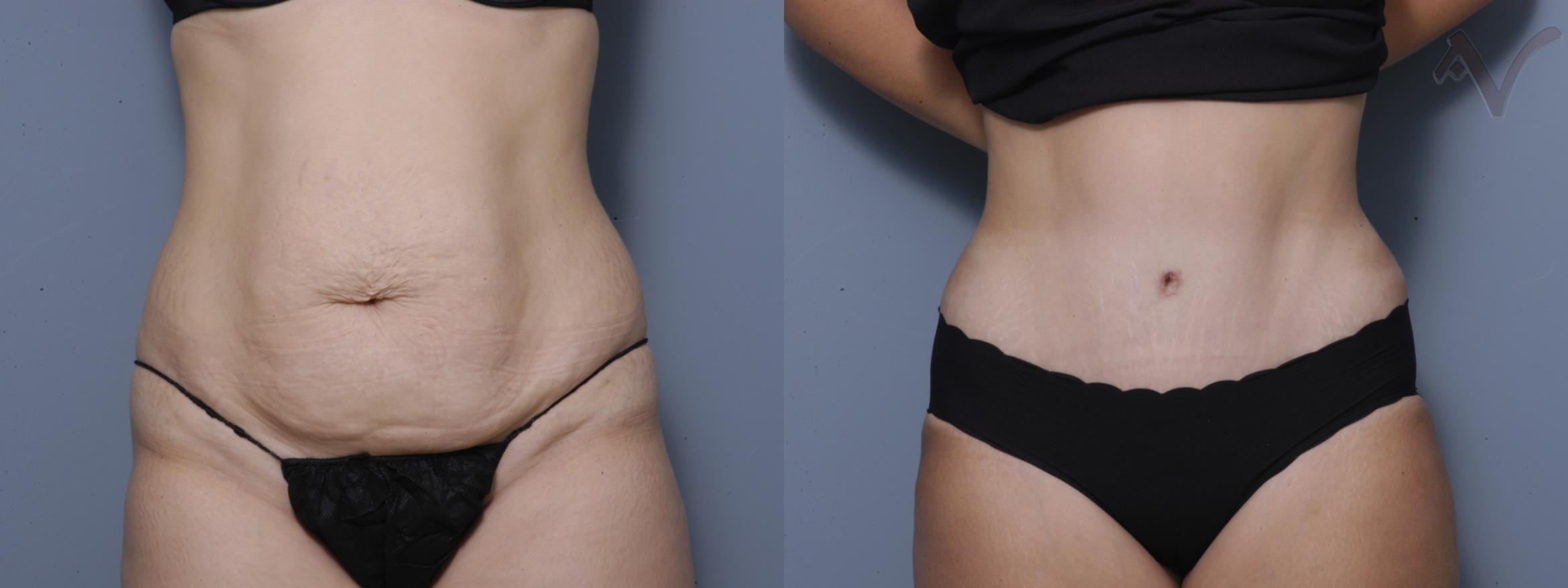 Before & After Tummy Tuck Case 183 Front View in Burbank, CA