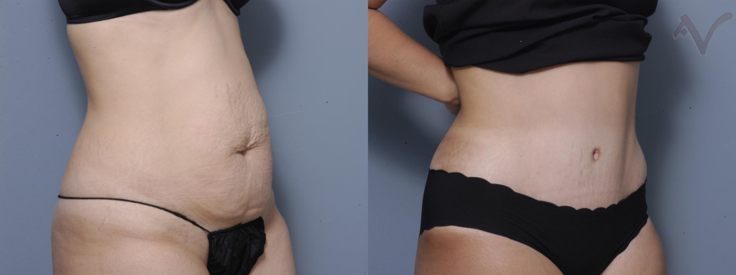 Before & After Tummy Tuck Case 183 Right Oblique View in Burbank, CA