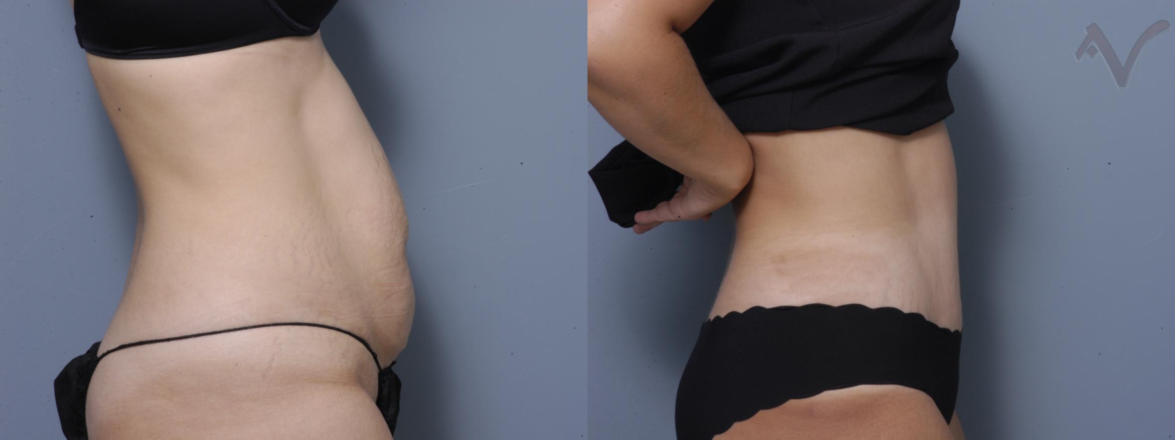 Before & After Tummy Tuck Case 183 Right Side View in Burbank, CA