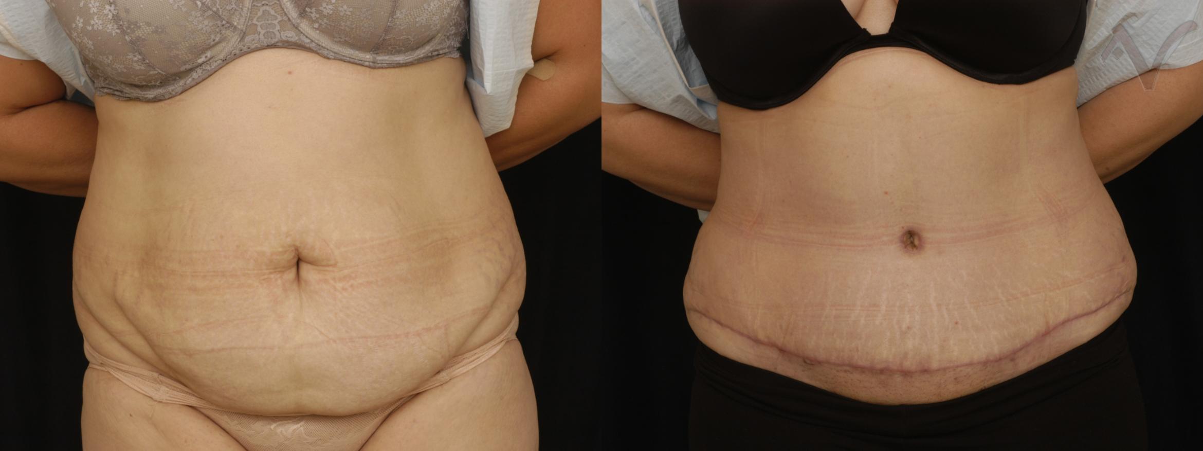 Before & After Tummy Tuck Case 185 Front View in Los Angeles, CA