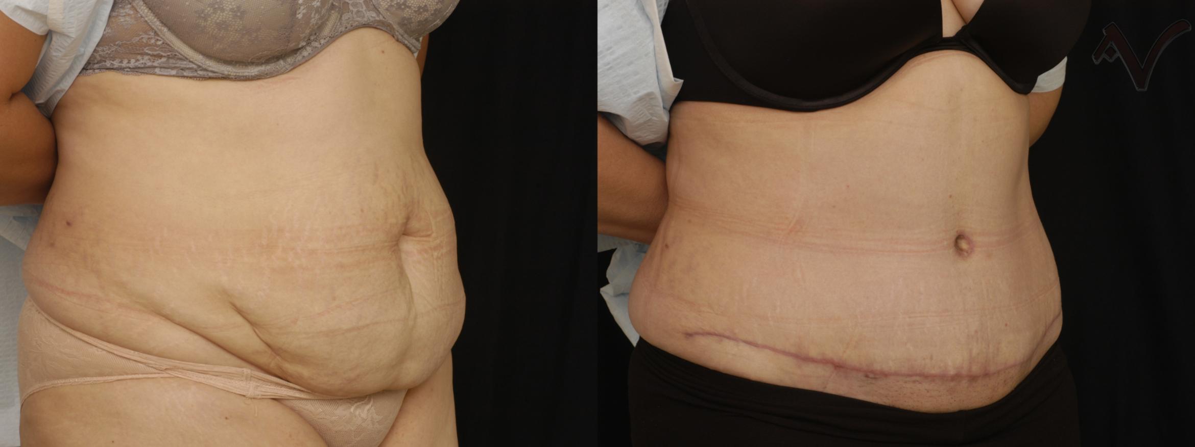Before & After Tummy Tuck Case 185 Right Oblique View in Los Angeles, CA