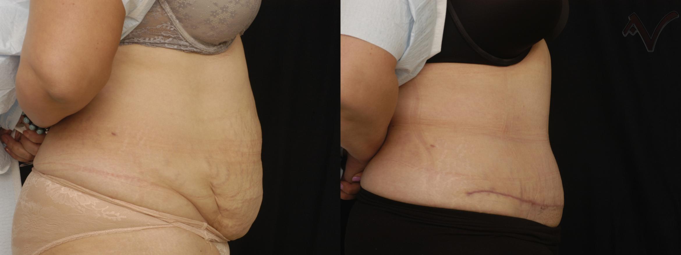 Before & After Tummy Tuck Case 185 Right Side View in Los Angeles, CA