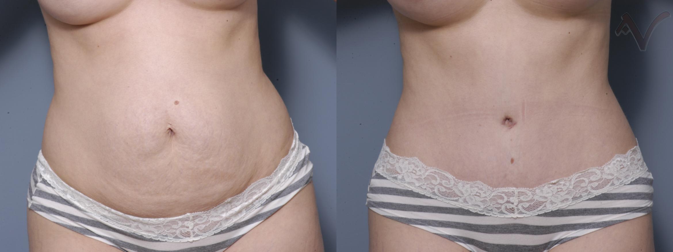 Before & After Tummy Tuck Case 191 Front View in Burbank, CA