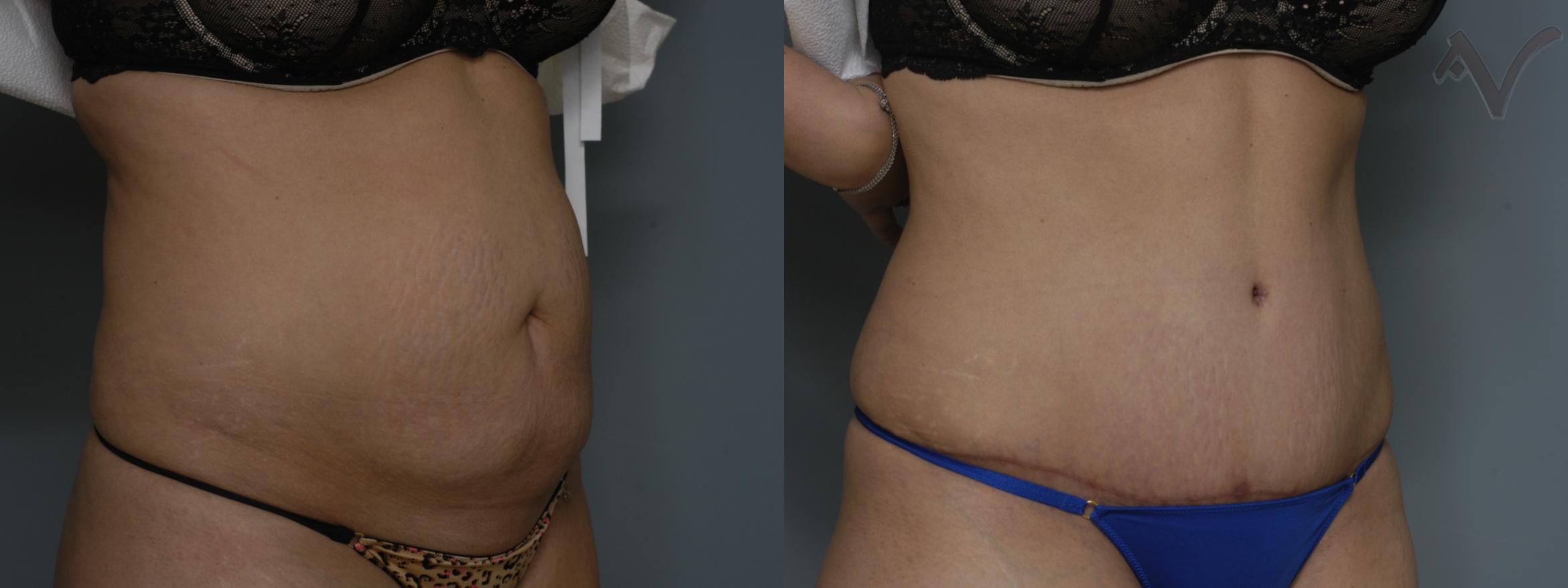 Before & After Tummy Tuck Case 192 Right Oblique View in Los Angeles, CA