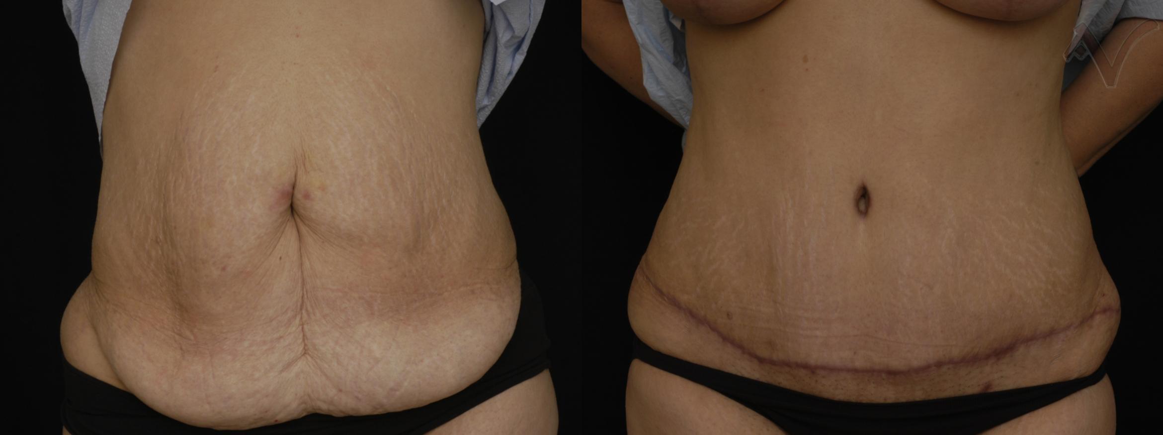 Before & After Abdominoplasty after Massive Weight Loss Case 201 Front View in Burbank, CA