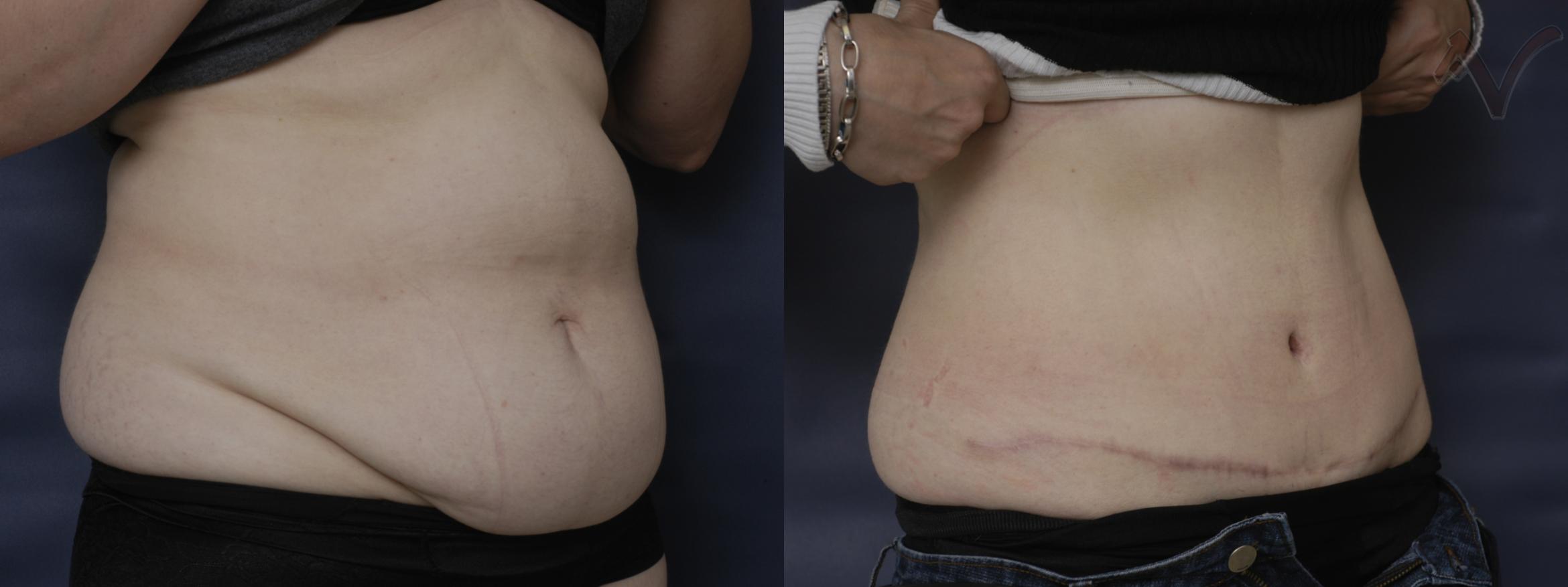 Before & After Tummy Tuck Case 203 Right Oblique View in Burbank, CA