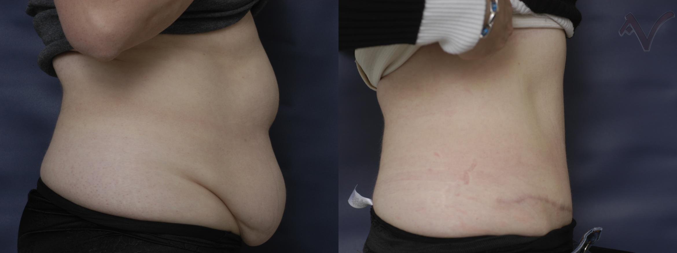 Before & After Tummy Tuck Case 203 Right Side View in Burbank, CA