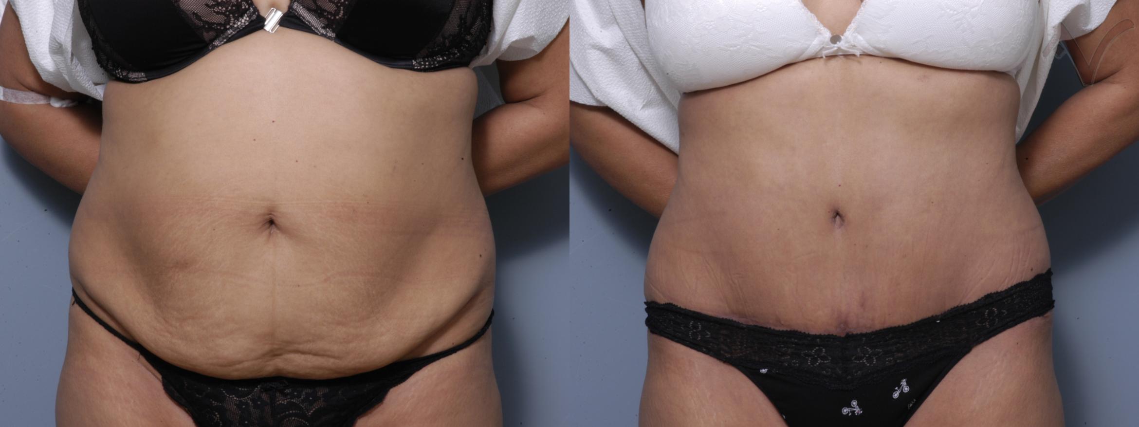 Before & After Tummy Tuck Case 207 Front View in Burbank, CA