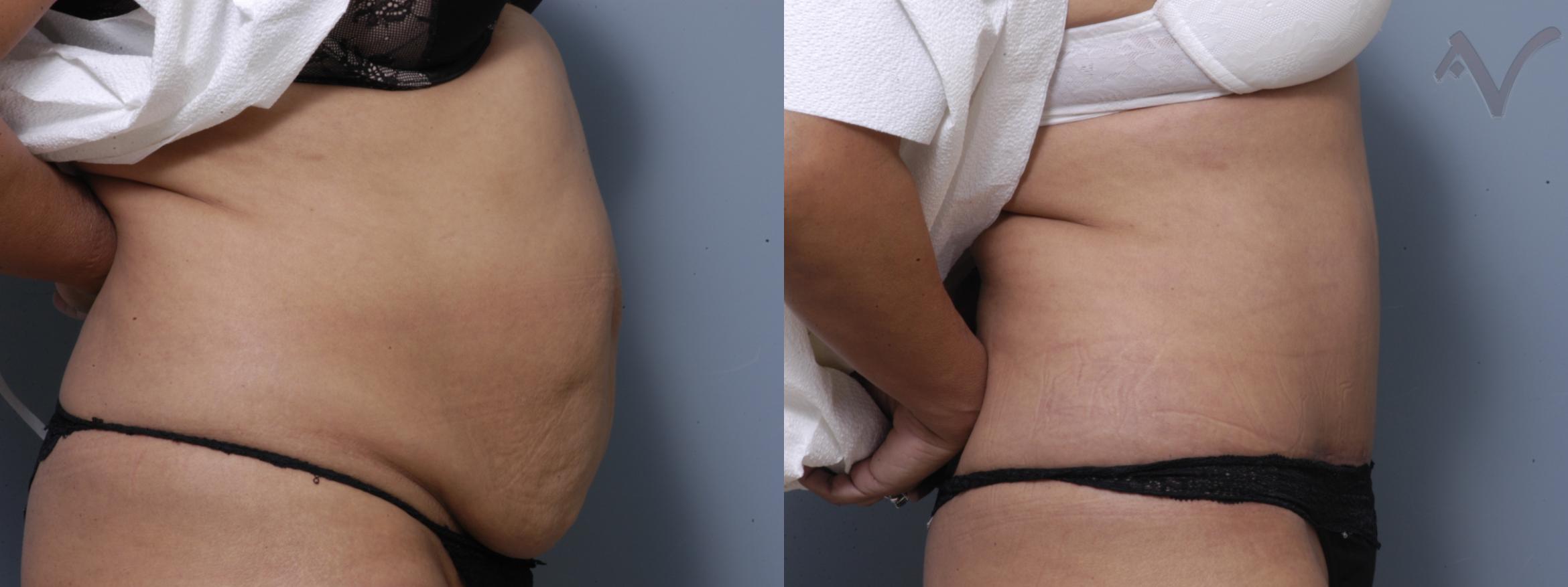 Before & After Tummy Tuck Case 207 Right Side View in Burbank, CA