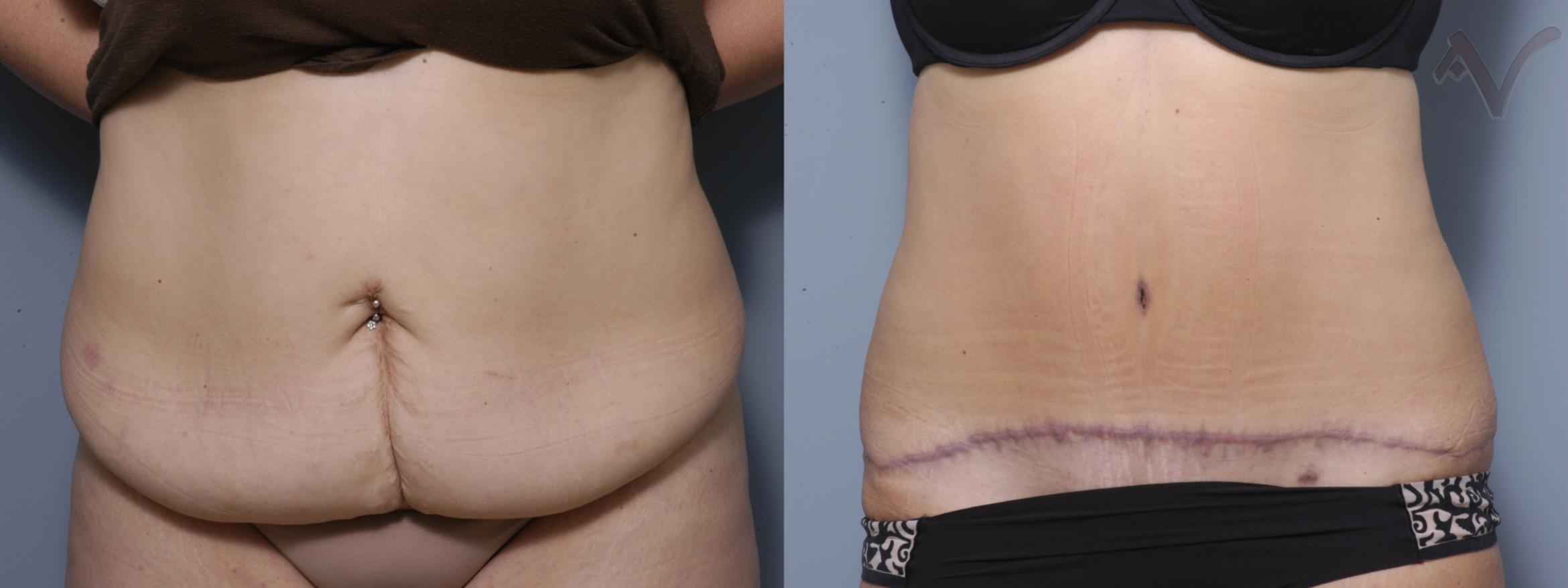 Before & After Tummy Tuck Case 208 Front View in Burbank, CA