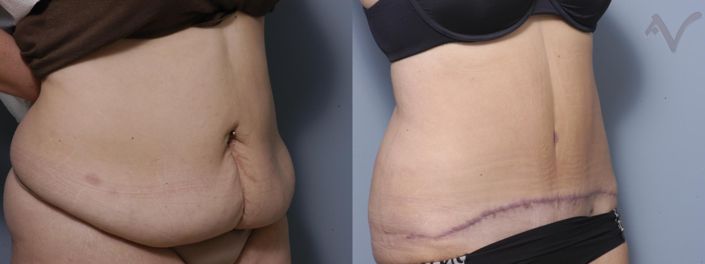 Before & After Tummy Tuck Case 208 Right Oblique View in Burbank, CA