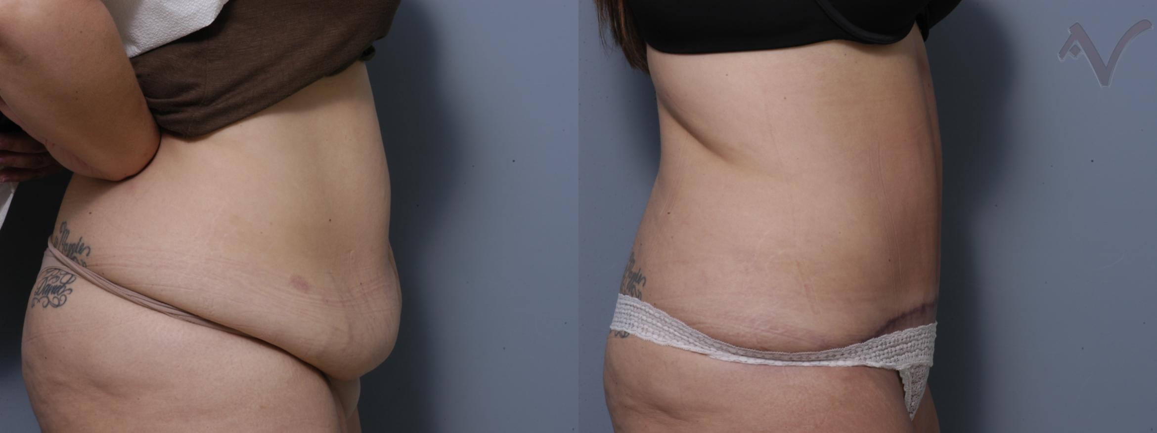 Before & After Tummy Tuck Case 208 Right Side View in Burbank, CA