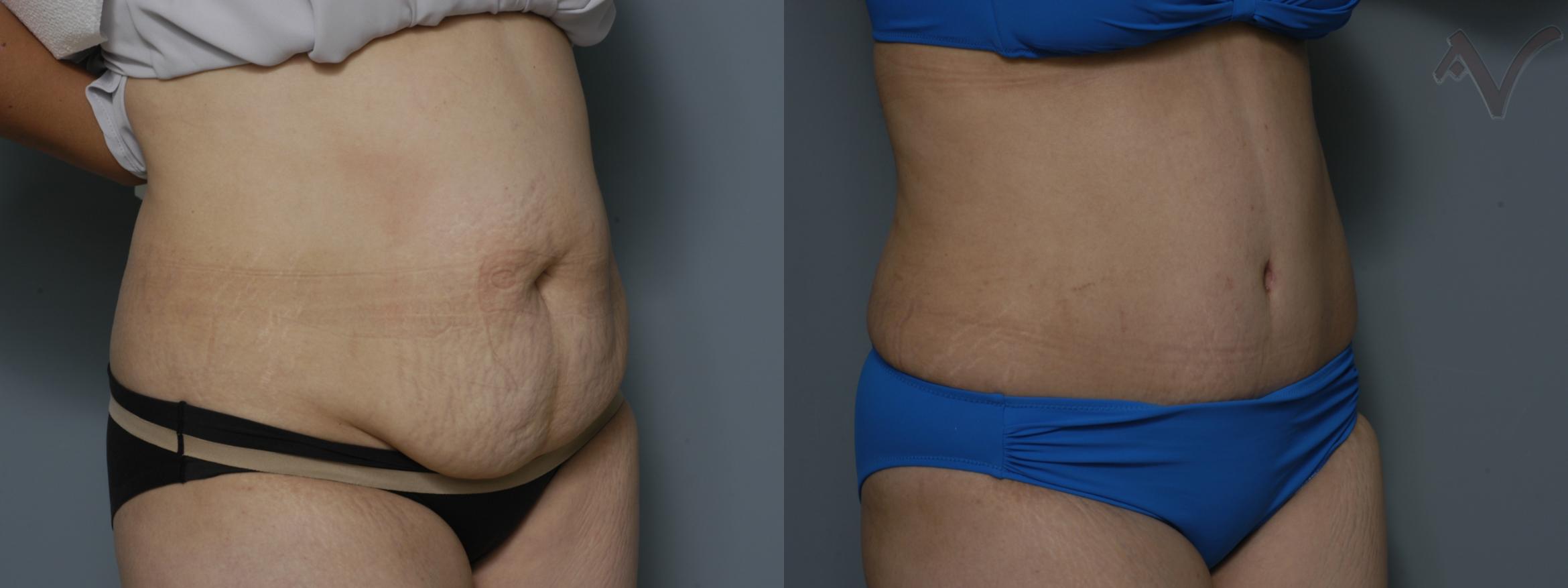 Before & After Tummy Tuck Case 211 Right Oblique View in Los Angeles, CA