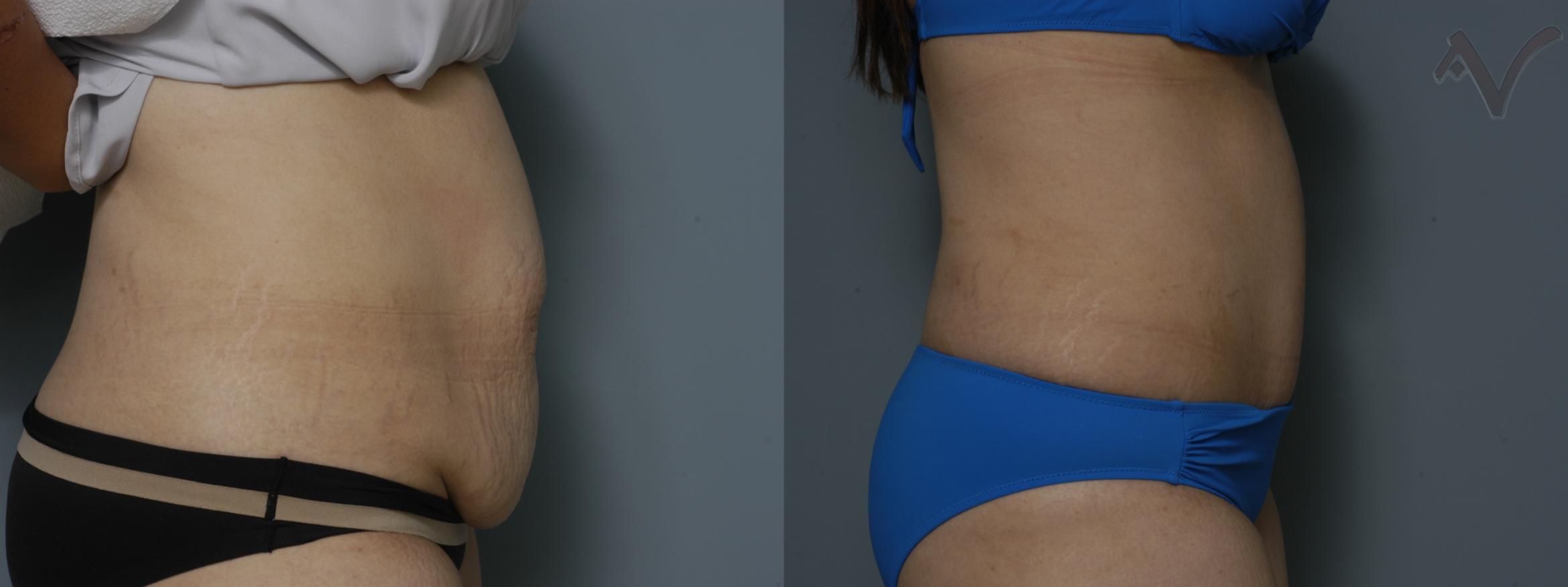 Before & After Tummy Tuck Case 211 Right Side View in Burbank, CA