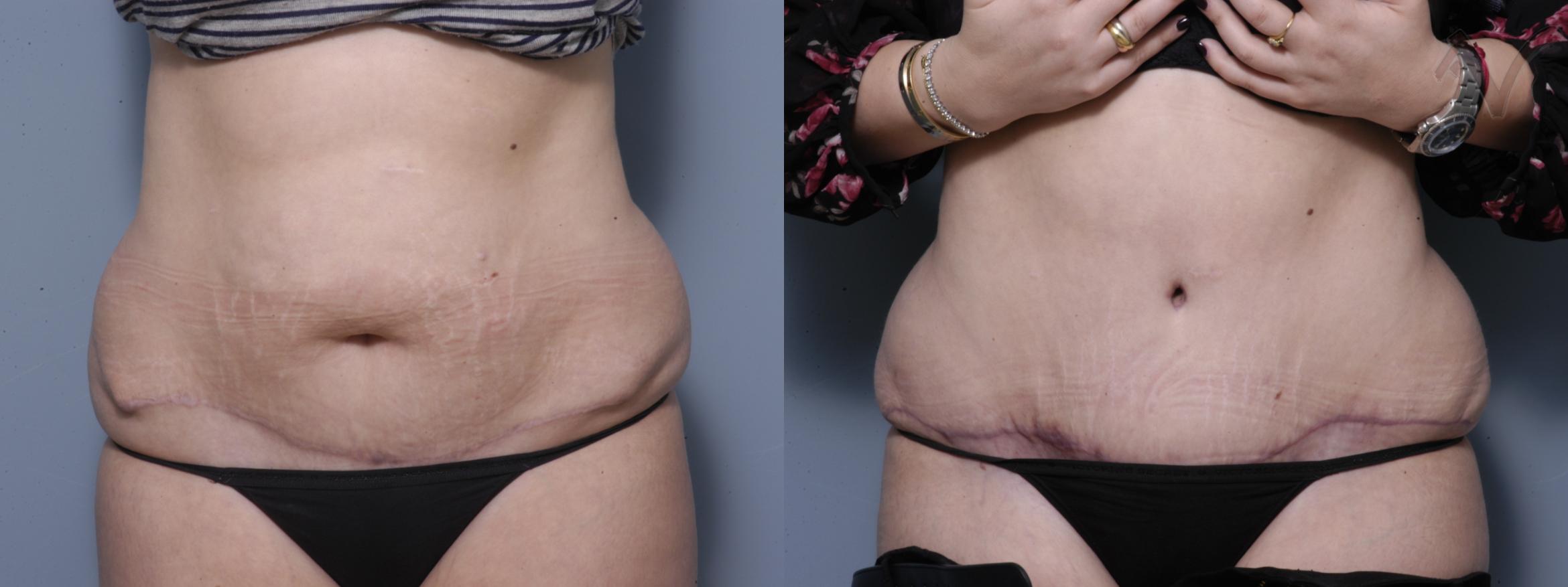 Before & After Tummy Tuck Case 218 Front View in Burbank, CA