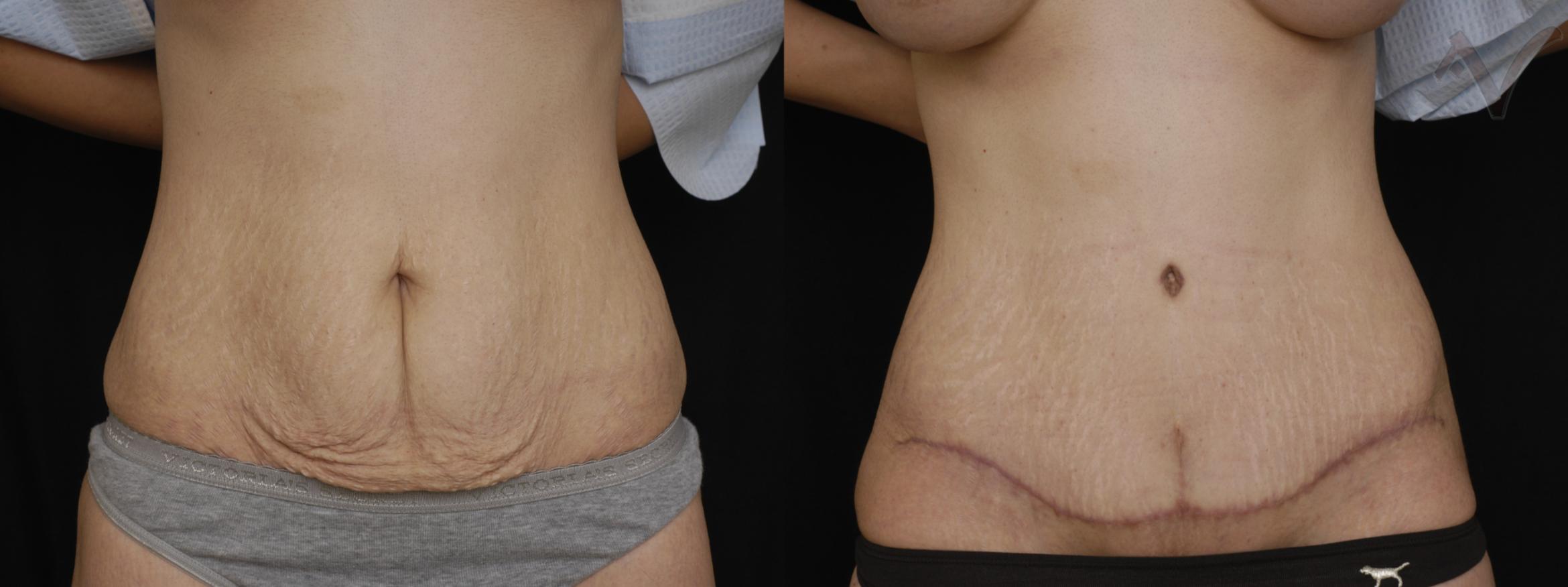 Before & After Tummy Tuck Case 236 Front View in Burbank, CA