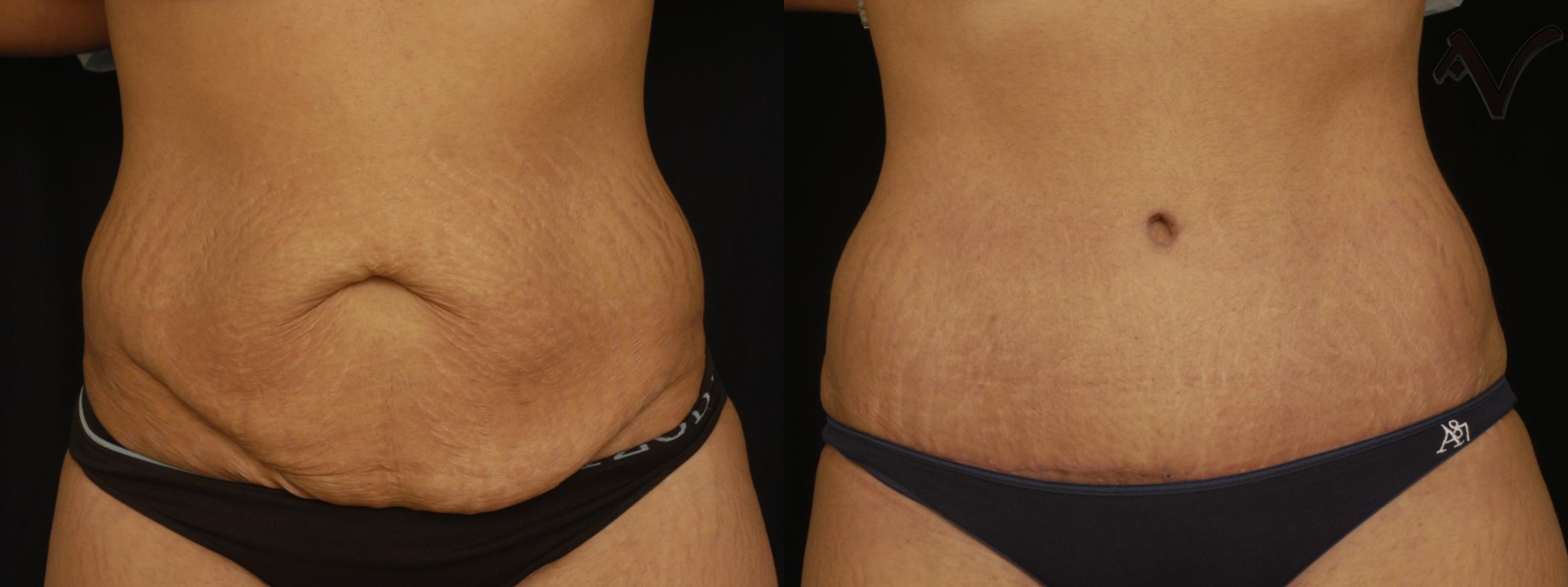 Before & After Tummy Tuck Case 237 Front View in Los Angeles, CA