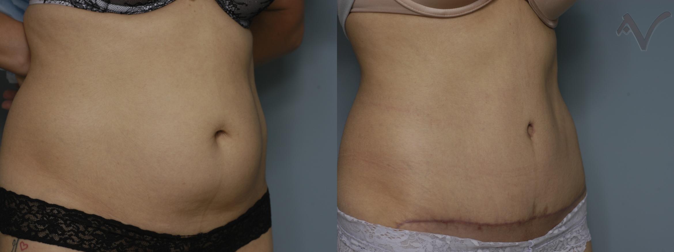 Before & After Tummy Tuck Case 238 Right Oblique View in Burbank, CA