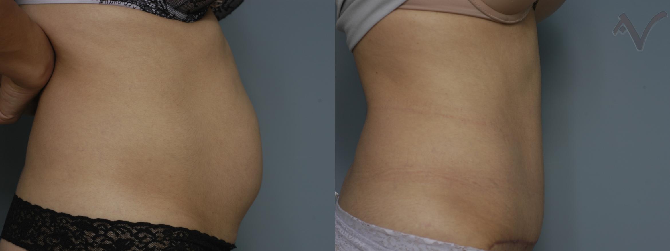 Before & After Tummy Tuck Case 238 Right Side View in Burbank, CA